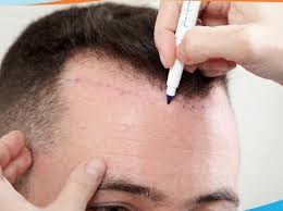 https://seedandspark-static.s3.us-east-2.amazonaws.com/images/User/001/389/752/medium/best%20hair%20transplants%20surgeon%20in%20dubai.jpg image